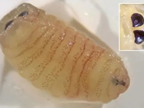 Người phụ nữ 58 tuổi “sốc nặng” khi hắt hơi ra hàng loạt con giòi sống từ trong mũi