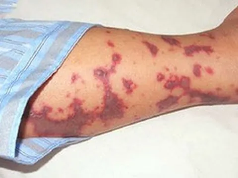 Não mô cầu tăng mạnh, trẻ em chiếm gần 50% ca mắc, nhận diện dấu hiệu 'tử thần'