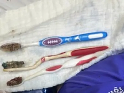 Nuốt liền 3 bàn chải đánh răng, nam thanh niên được cứu kịp thời