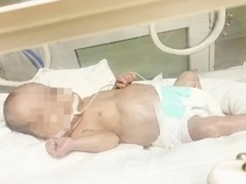 120 ngày giành giật sự sống cho bé sinh non 500gr phải thở máy kéo dài