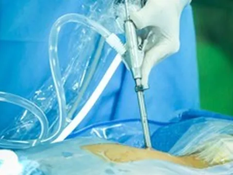 Bệnh lý cột sống: Bước tiến khoa học từ các kỹ thuật ít xâm lấn thế hệ mới