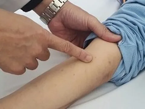 Bệnh não mô cầu gia tăng, bác sĩ cảnh báo triệu chứng dễ nhầm với cảm cúm