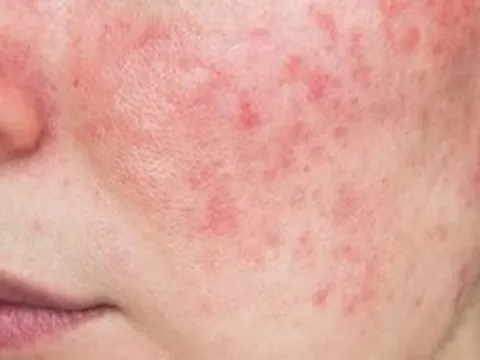 Hiểm họa khi tự ý lạm dụng thuốc, mỹ phẩm chứa corticoid