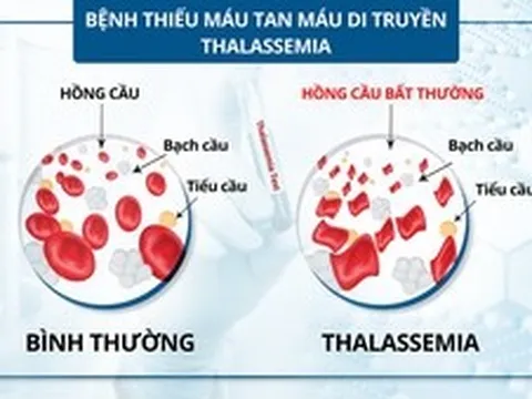 Bệnh tan máu bẩm sinh: Bệnh di truyền lặn nhưng phổ biến nhất ở Việt Nam và thế giới