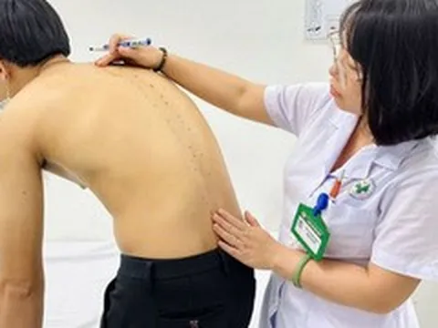 Tưởng đau lưng do tập gym, chàng trai 20 tuổi mắc viêm cột sống dính khớp