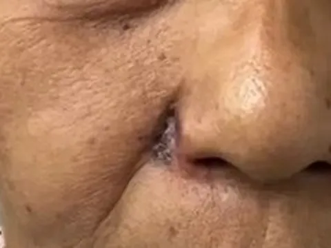 Tưởng nốt ruồi thông thường, người phụ nữ bị ung thư phá hủy toàn bộ cánh mũi