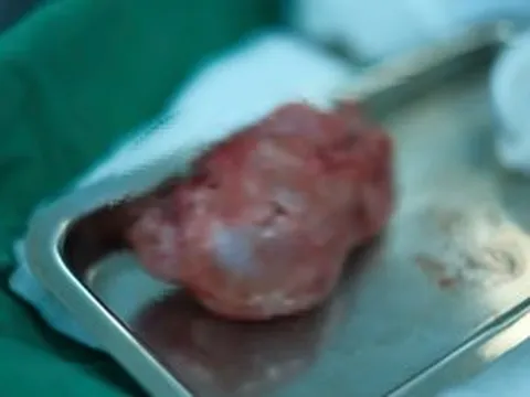 Bé 10 ngày tuổi bụng phình to, kết quả thăm khám khiến gia đình bàng hoàng