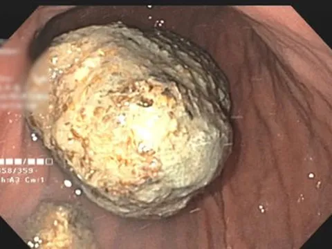 Tưởng đau bụng thông thường, người đàn ông 67 tuổi mang trong mình thứ "đáng sợ" khiến bác sĩ sốc ngang