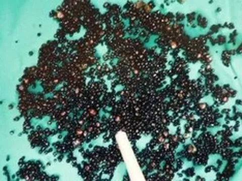 Đau bụng suốt nhiều tháng, người đàn ông 43 tuổi sốc nặng khi bác sĩ gắp ra thứ "đáng sợ" trong bụng