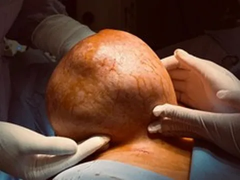 Mang "quả tạ" gần 4kg suốt nhiều năm, người phụ nữ bàng hoàng khi biết sự thật
