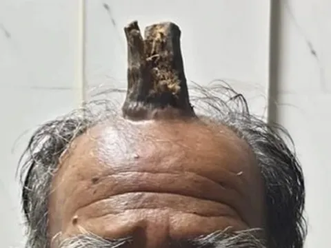 Người đàn ông mọc "sừng quỷ" dài 10 cm trên đầu và cái kết bất ngờ
