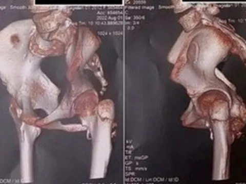 Lần theo dấu vết bất thường, bác sĩ phát hiện bệnh 'người hóa đá' hiếm gặp