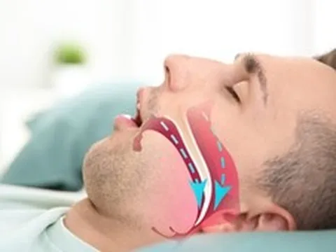Ngáy to bị vợ giục đi khám, phát hiện căn bệnh có thể dẫn đến đột quỵ