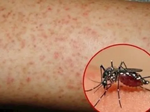 Sốt xuất huyết Dengue: Thay đổi khó lường, lan rộng và phức tạp hơn