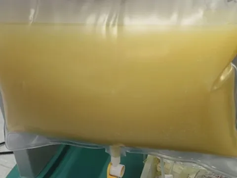 Máu trắng đục như sữa, nam sinh viên gặp biến chứng vì kiểu ăn uống quen thuộc