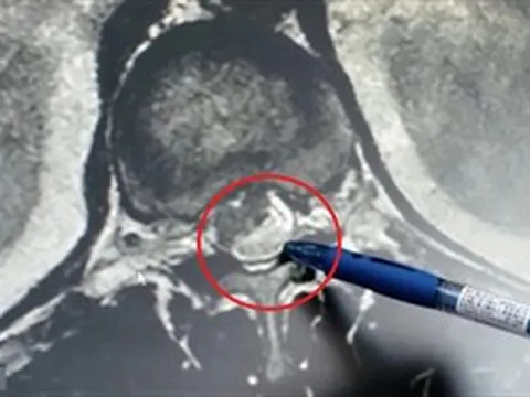 Ăn món khoái khẩu, người đàn ông 55 tuổi "rước" ấu trùng sán dây vào tủy sống suốt 12 năm mà không hay