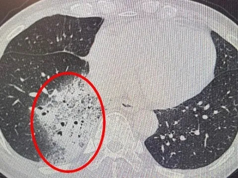 Người phụ nữ 40 tuổi "phổi trắng xoá" vì thói quen phổ biến này