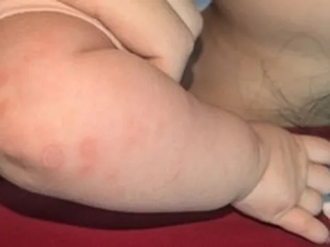 Bé 2 tháng tuổi mắc giang mai