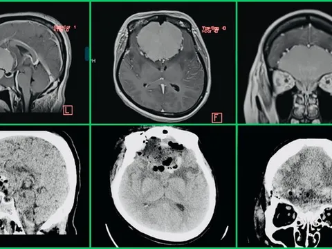 Mờ mắt tăng dần, không ngờ có khối u màng não khổng lồ