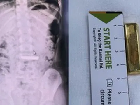 Bé gái 5 tuổi nuốt thỏi vàng dài 4cm vào bụng