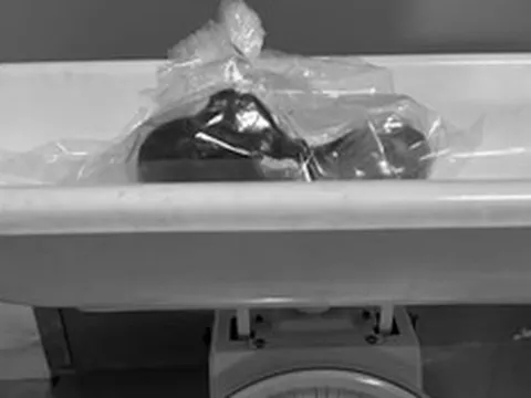 Bé gái 5 tuổi biểu hiện lạ, bác sĩ gắp ra thứ "đáng sợ" trong bụng