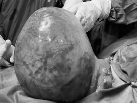 Tưởng béo bụng, người phụ nữ 51 tuổi bất ngờ phát hiện khối u nặng 6kg