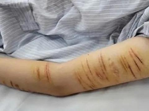 Vết rạch trên tay nữ sinh lớp 10 và nỗi đau không thể nói thành lời