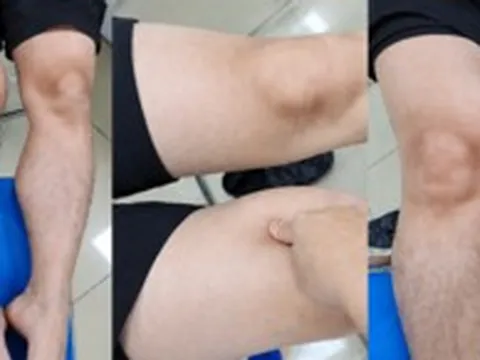 Đùi phình to như quả bóng suốt 1 năm, đi khám phát hiện ung thư hiếm gặp