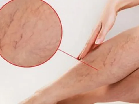 Tưởng mỏi chân do đứng bán hàng, đi khám phát hiện tĩnh mạch hiển suy nặng