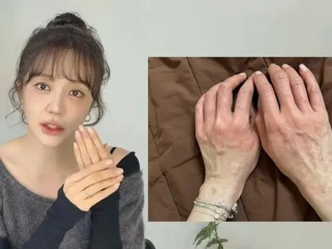 Yoon Eun Hye bị dị ứng nghiêm trọng, hai tay sưng đỏ rồi lan khắp mặt
