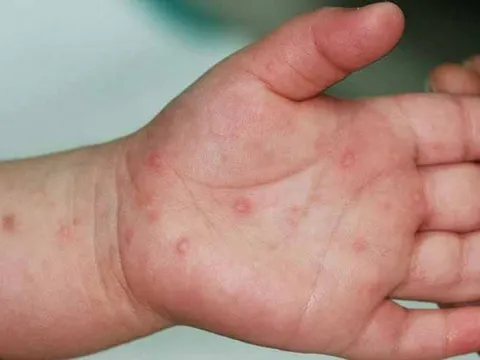 Tp.HCM ghi nhận số ca tay chân miệng tăng 47% trong một tuần