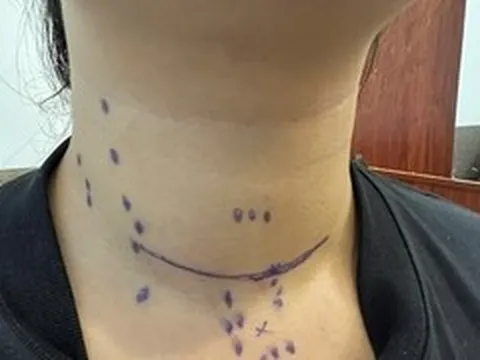 19 tuổi phát hiện ung thư tuyến giáp sau khám sức khỏe định kỳ
