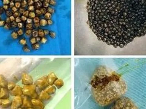 Bác sĩ bất ngờ khi gắp 49 viên sỏi trong túi mật người phụ nữ