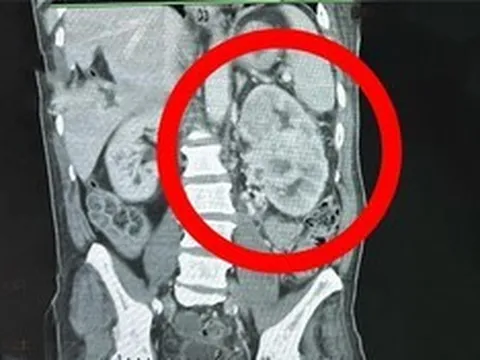 Có dấu hiệu này nhưng không đi khám, người đàn ông 64 tuổi mắc ung thư giai đoạn 4