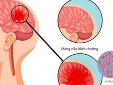 Bệnh não mô cầu có thể gây tử vong nhanh, chuyên gia cảnh báo những dấu hiệu nguy hiểm