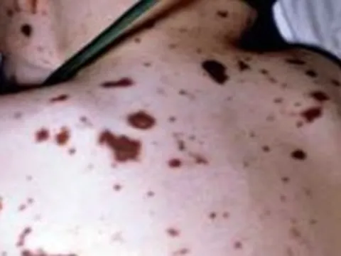 TP.HCM ghi nhận thêm 1 ca mắc viêm não mô cầu