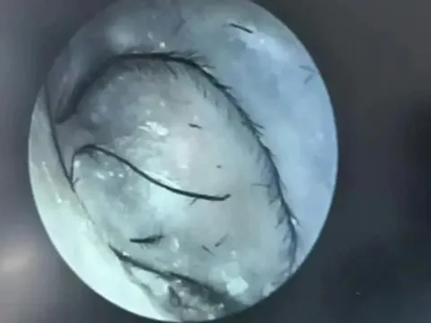 Người phụ nữ ngứa tai đi khám, bác sĩ phát hiện thứ bất ngờ bên trong