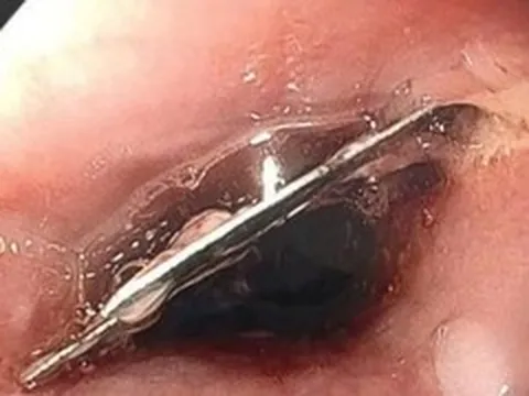 Ăn mì tôm thấy đau họng, đến viện phát hiện lưỡi dao lam trong thực quản