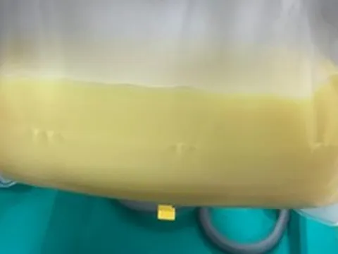 Người phụ nữ 32 tuổi máu "trắng đục như sữa", bác sĩ "chỉ mặt điểm tên" thói quen ít ai ngờ