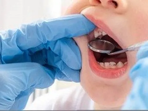 Khám sức khỏe toàn dân, TP.HCM phát hiện 24,9% học sinh sâu răng