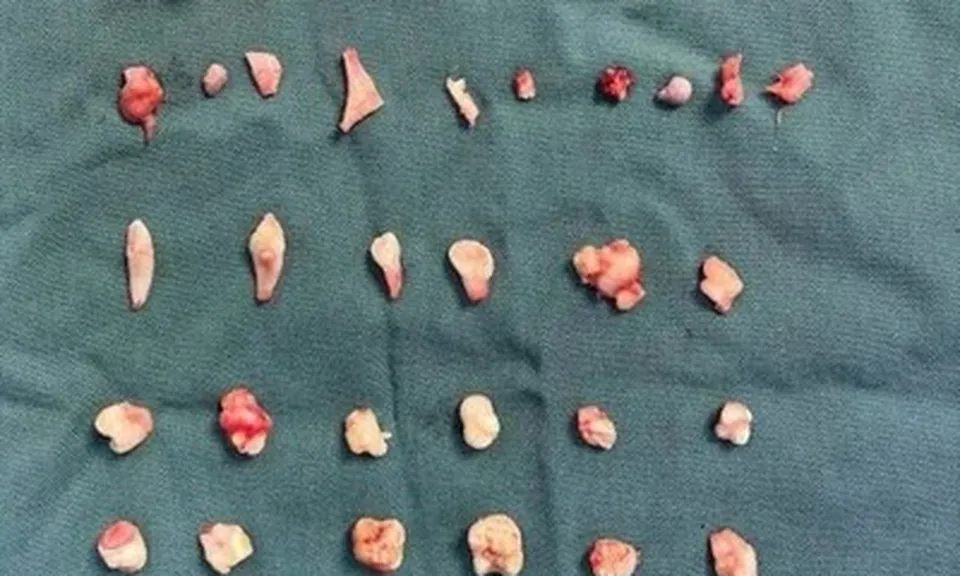 Cô gái đau bụng dữ dội, bác sĩ phát hiện ra bí mật bên trong